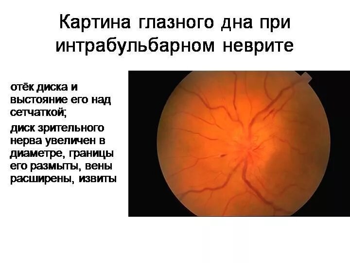 Интрабульбарный неврит зрительного нерва. Офтальмоскопия диска зрительного нерва. Интрабульбарный неврит клинические рекомендации. H46 неврит зрительного нерва..