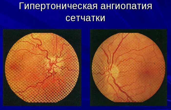 Ангиопатия сосудов мкб. Ангиопатия сосудов глазного дна. Гипертоническая ангиопатия сетчатки. Ангиопатия сетчатки глазное дно. Гипертоническая ангиопатия сетчатки глазное дно.