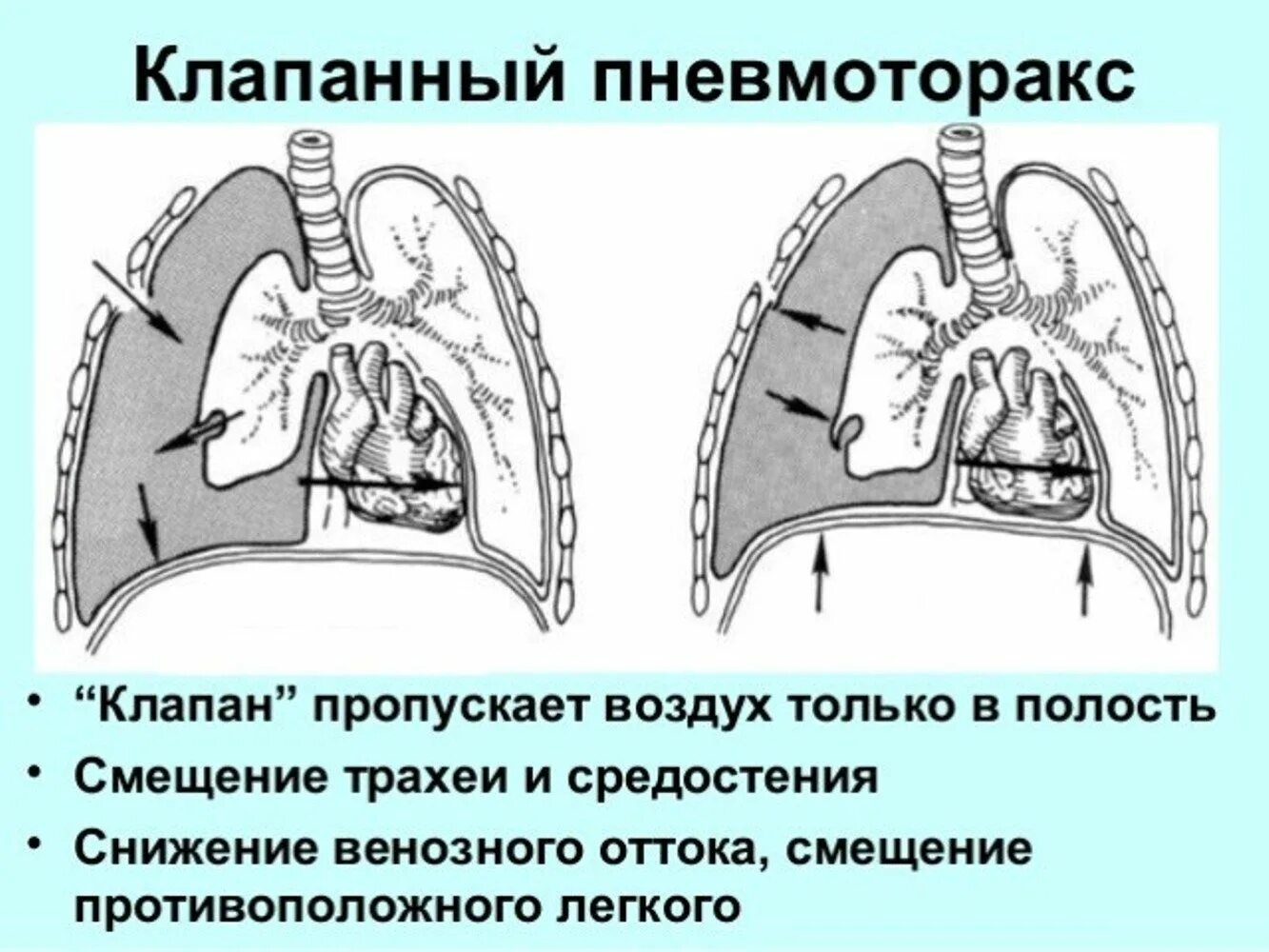 Открытый пневмоторакс закрытый пневмоторакс клапанный. Наружный клапанный пневмоторакс. Клапанный пневмоторакс механизм. Напряженный клапанный пневмоторакс симптомы.