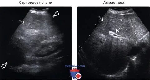 Паренхима печени на узи