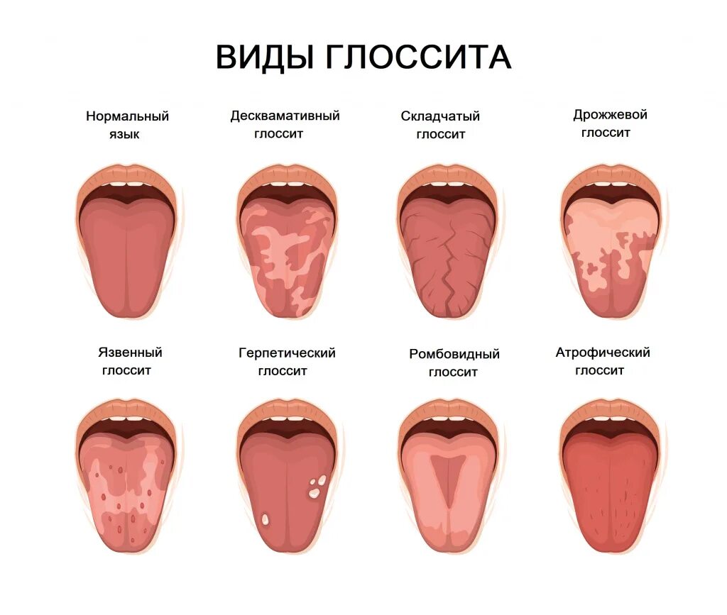 Боли во рту причины и лечение. Язык злоровог очеловека.