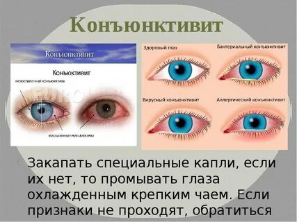 Конъюнктивит у взрослых отзывы