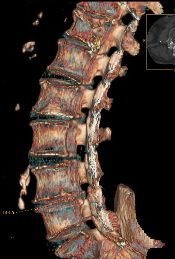 Кт пояснично-крестцового отдела. Компьютерная томография пояснично-крестцового отдела позвоночника. К-Т поясничного кресцово отдела. Кт грудо поясничного отдела позвоночника.