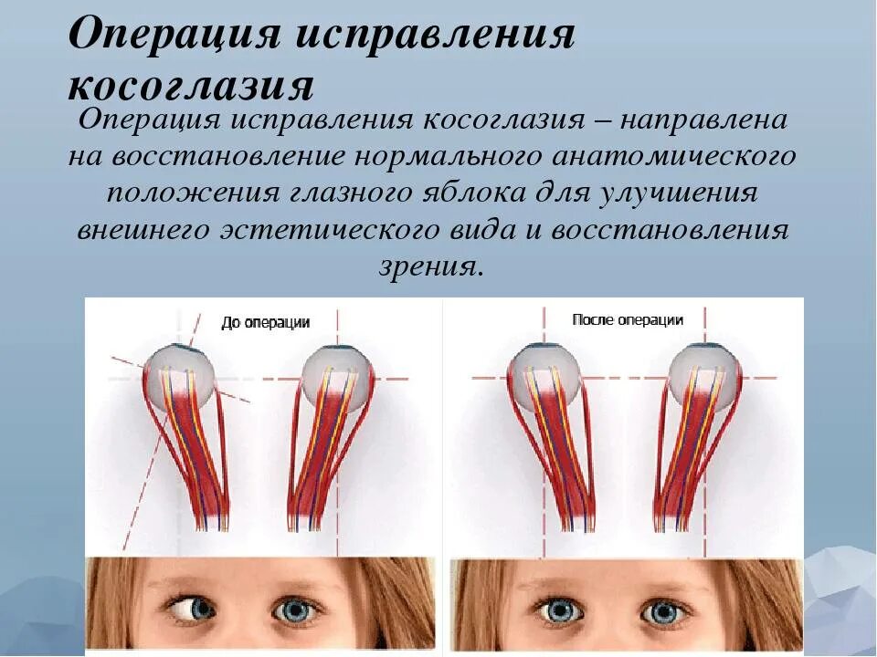 Операция на косоглазие цена. Операция на глаза склеропластика.