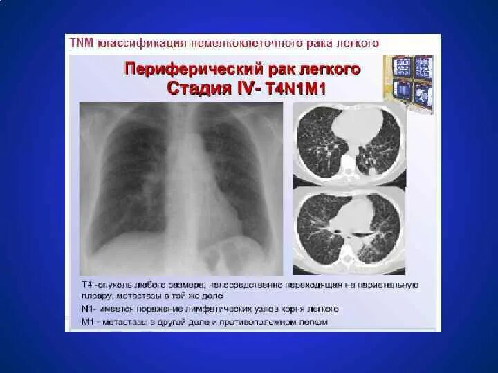 С метастазами 4 степени сколько живут. Стадии опухоли легкого. Карцинома легких 4 стадия. Онкология 4 стадии с метастазами в легкие. Четвёртая стадия онкологии лёгких.