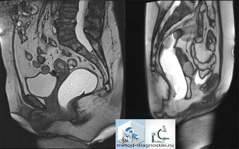 Мрт ОМТ малого таза. Варикозное расширение вен таза мрт. Пролапс органов малого таза мрт. Мрт малого таза с контрастированием снимки.