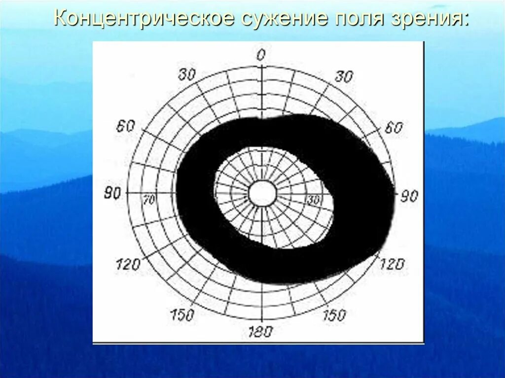 Центральное поле зрения. Сужение поля зрения периметрия глаукома. Концентрическое сужение полей зрения. Поля зрения при неврите. Трубчатое поле зрения.