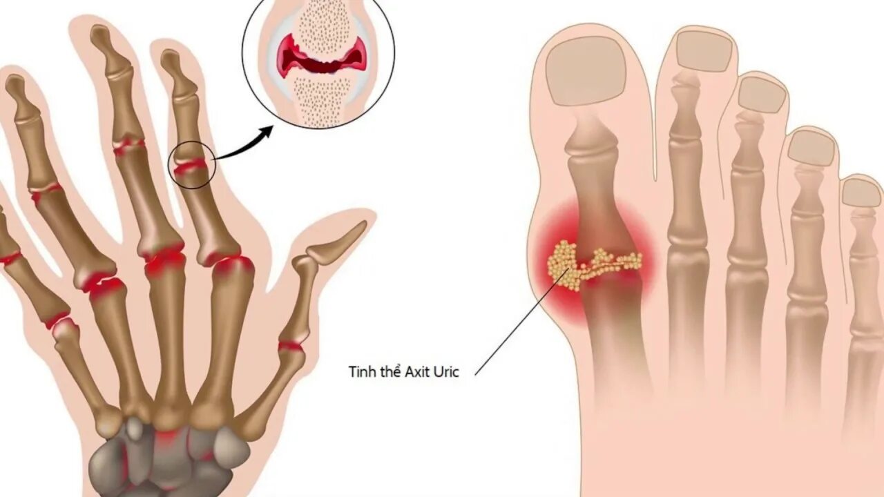 Суставы кисти руки. Подкожные узелки ревматоидный артрит. Из чего хрустят пальцы. Ведро ли хрустеть пальцами на руках. Вредно ли хрустеть пальцами.