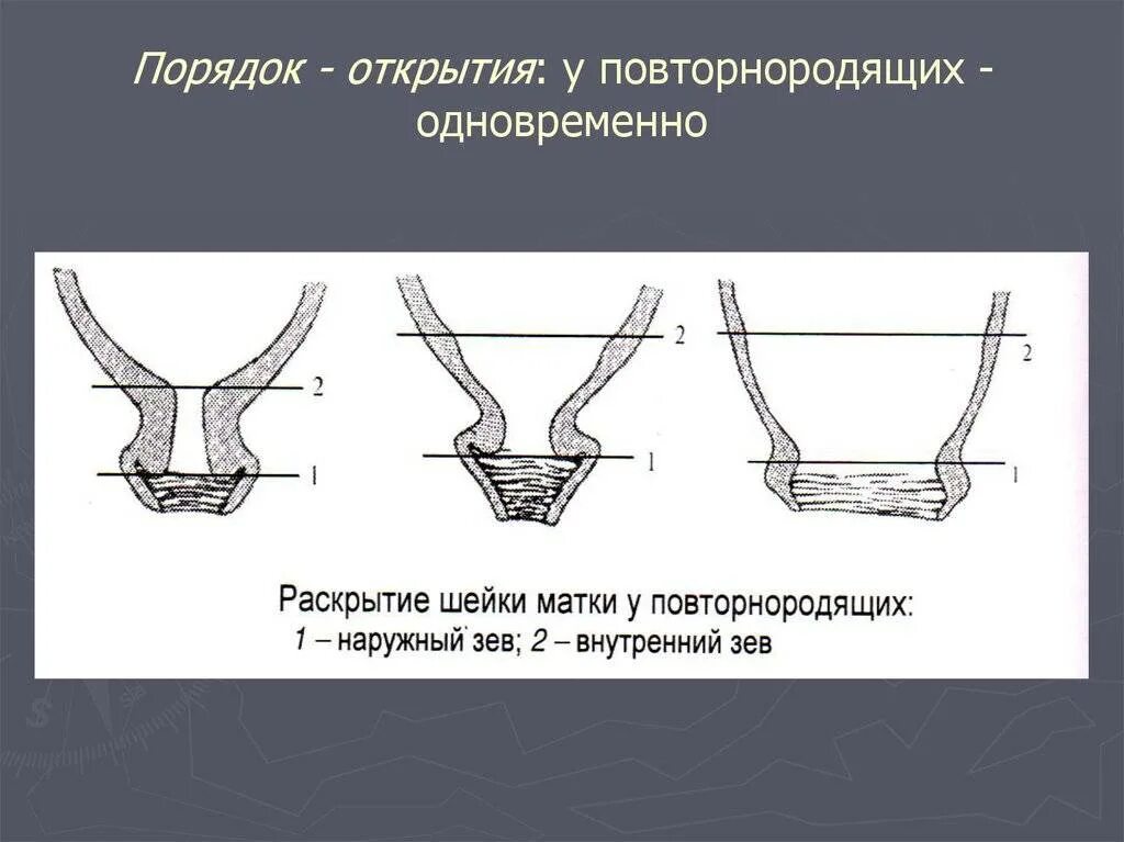 На сколько пальцев родах. Раскрытие шейки. Раскрытие шейки у повторнородящих. Открытие шейки.