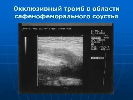Окклюзивный тромбоз