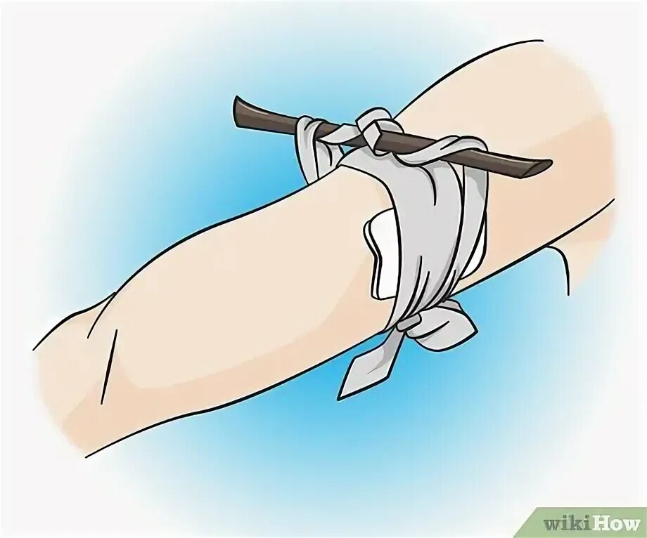 Step wound. Целокс для остановки кровотечения. Этапы ангиогенеза при заживлении ран. Celox rapid. Step wound.