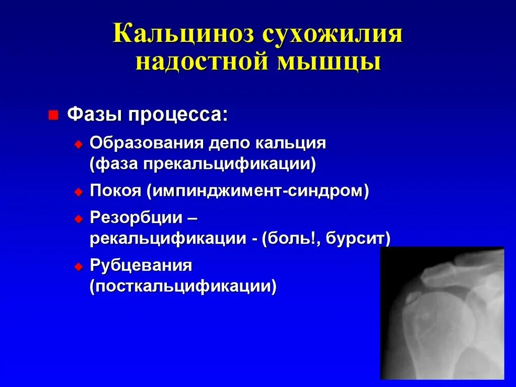Обызвествление места прикрепления сухожилий. Кальцинирующая тендопатия сухожилия надостной мышцы. обызвествление сухожилия. обызвествления в плечевом суставе.