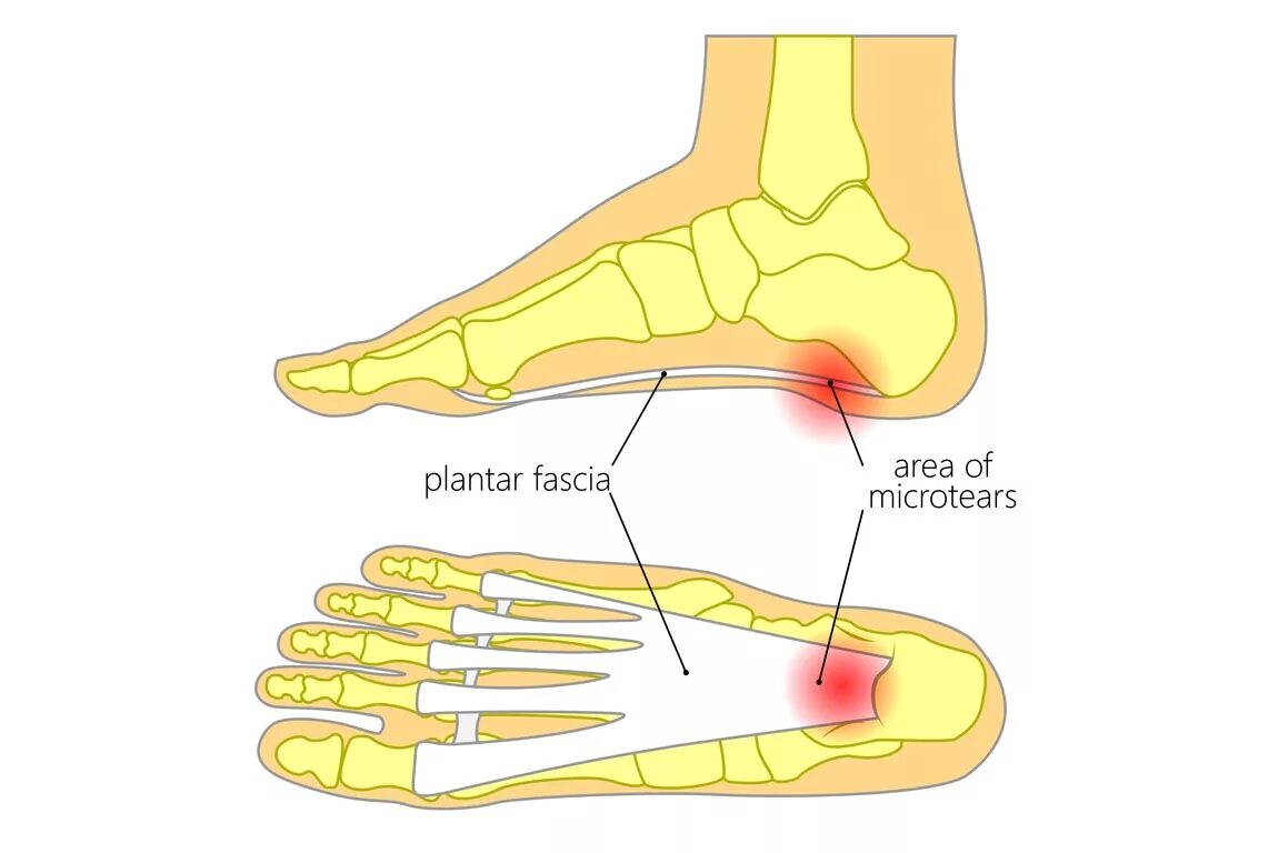 Боли в стопе снизу. Фасциит подошвенного апоневроза.