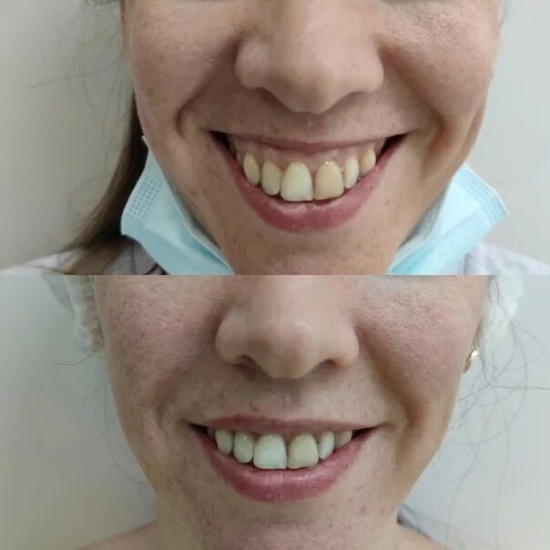 Коррекция smile clinicaspectr ru. Десневая улыбка Gummy smile. Исправление десневой улыбки. Коррекция десневой улыбки. Коррекция десневой улыбки ботулотоксином.