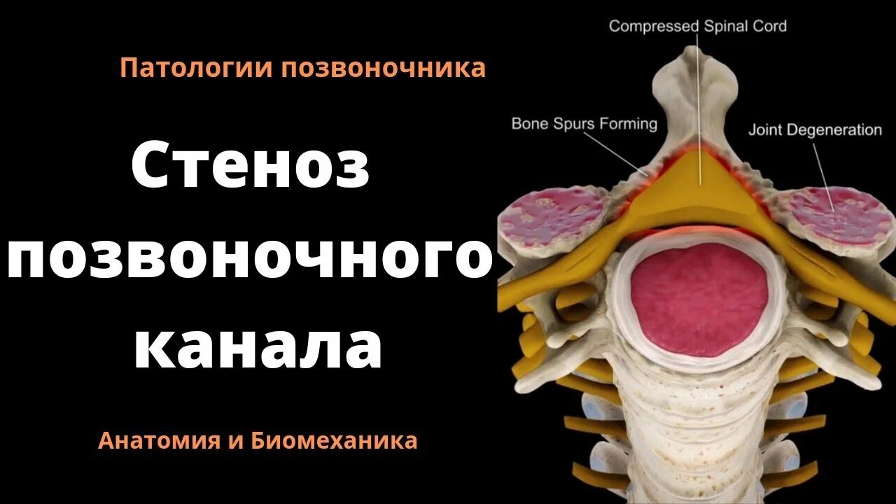 Лечение стеноза позвоночника без операции. Сужение просвета позвоночного канала. стеноз позвоночного канала. узкий позвоночный канал. стеноз поясничного отдела позвоночника.