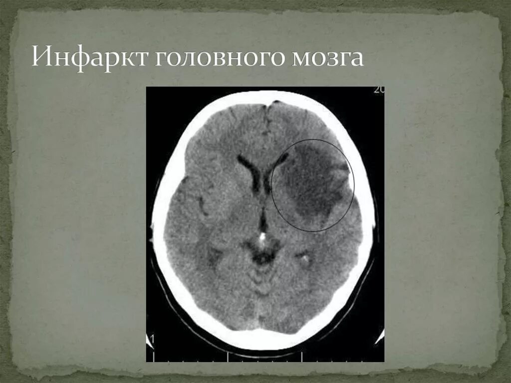 Инфаркт мозга неуточненный. Инфарктголовногомозка. Ишемический инфаркт головного мозга. Что такое микроинфаркт головного мозга.