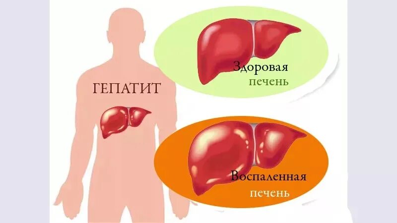 Печень а б д. Поражение печени при гепатите с. гепатит б болезнь печени. печень пораженная гепатитом.