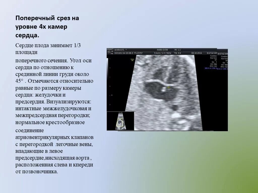 УЗИ сердца плода ось сердца. Анатомия сердца плода на УЗИ. Гипоплазия левого желудочка у плода на УЗИ. Четырехкамерный срез сердца