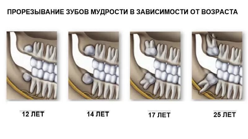 Почему зубы мудрости так называются. Прорезавшиеся зубы мудрости. Этапы прорезывания зубов мудрости. Когда вырастают зубы мудрас.