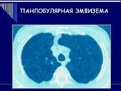 Парасептальная эмфизема на кт