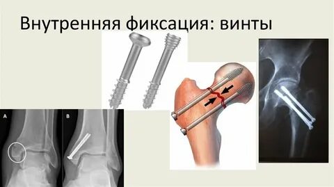 Перелом травматологи