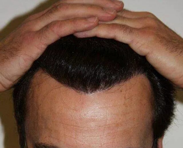 м образные волосы. м образные волосы. линия волос у мужчин. м образные волосы. м образные волосы.