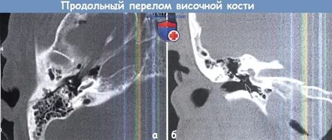 Перелом височной кости