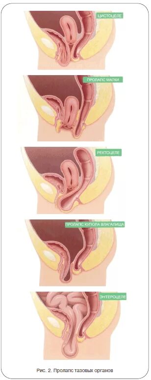 Почему раскрывается матка. Урогенитальный пролапс. Опущение стенок влагалища 1 степени. Пролапс выпадение матки. Опущение задней стенки матки.