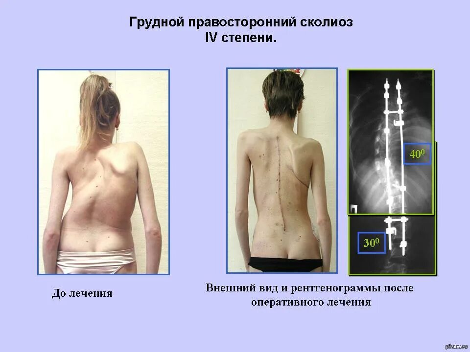 Деформация грудной клетки сколиоз. Правосторонний сколиоз 3 степени. Левосторонний грудной сколиоз 2 степени. Правосторонний грудной сколиоз 2 степени.