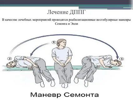 Пароксизмальное позиционное головокружение упражнения