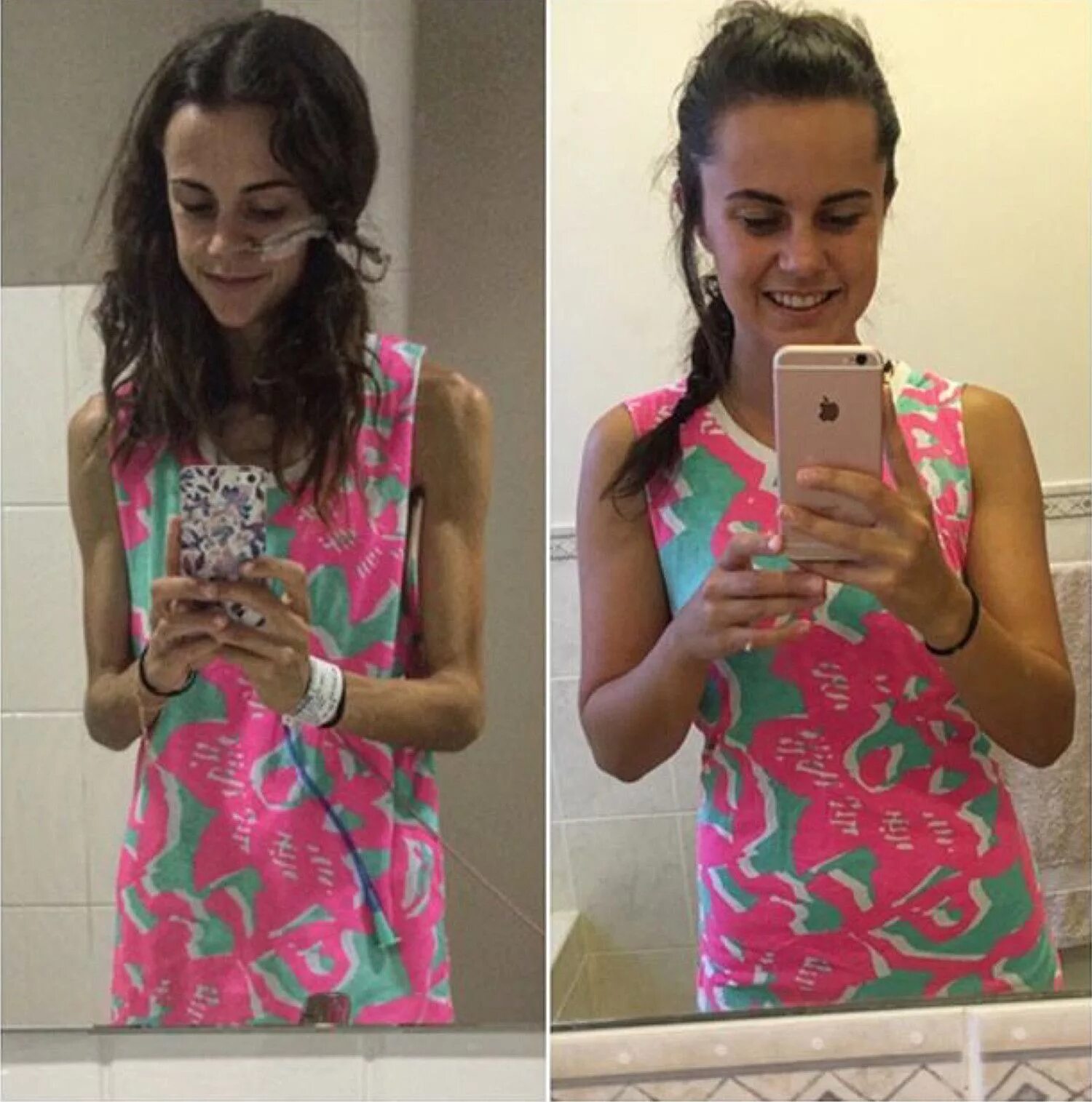 Виталий игнатьев диета. Преображения людей после похудения. Девушки после анорексии. Похудение до и после. Похудела до и после.