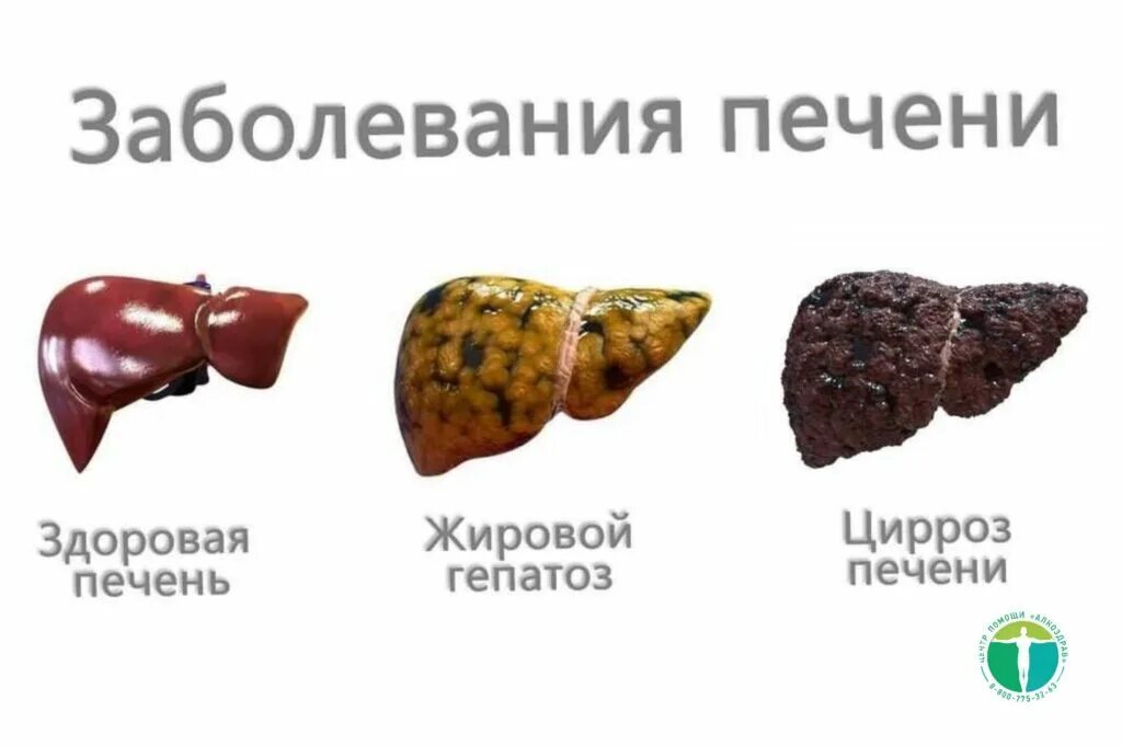 Как выглядит гепатоз печени фото