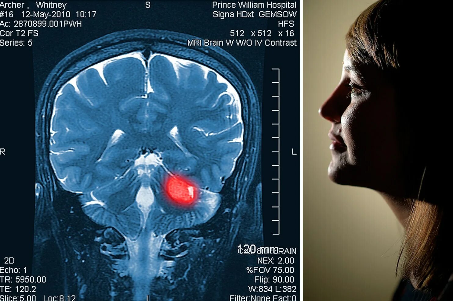 Brain first. Объемное образование головного мозга. Злокачественная опухоль головного мозга.