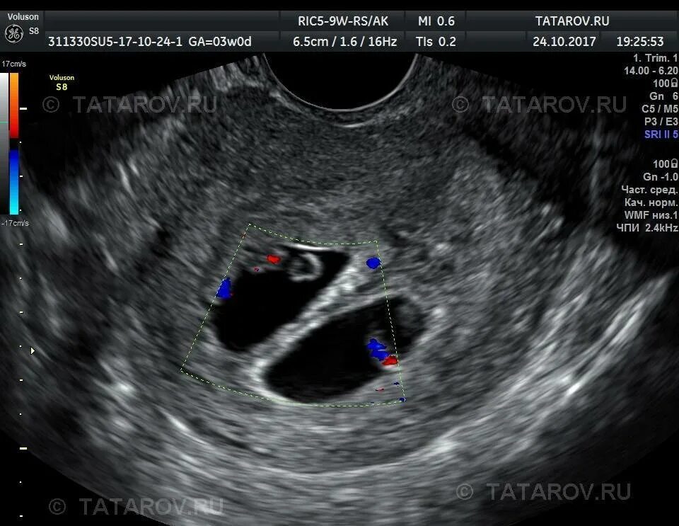 УЗИ двухплодной беременности. Два плодных яйца на УЗИ 5 недель беременности. Как выглядит эмбрион в 5 недель на УЗИ. УЗИ многоплодной беременности 5 недель. 2 недели видно на узи