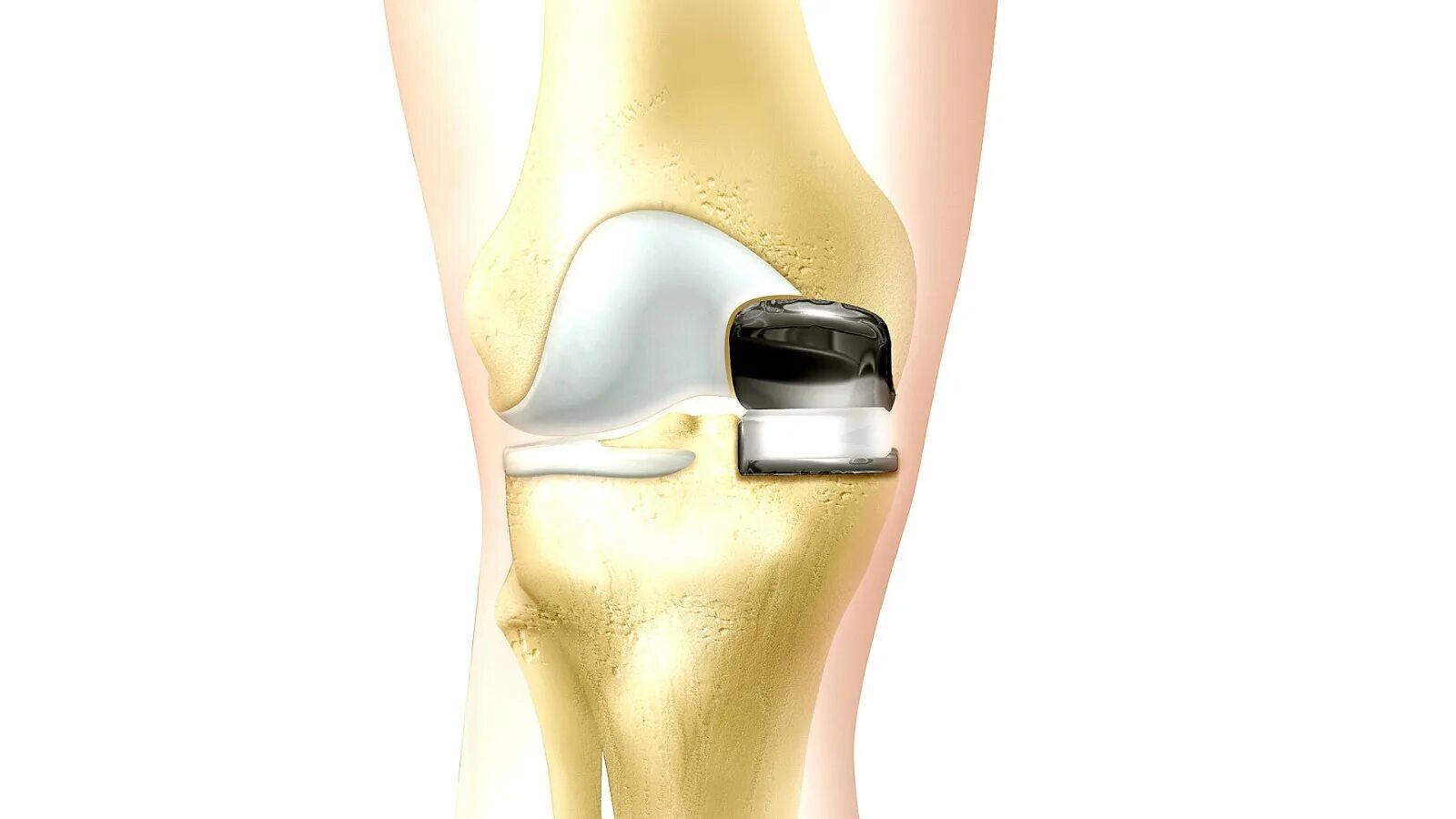 Протез коленного сустава Zimmer NEXGEN complete Knee solution. Эндопротезирование коленного сустава Zimmer NEXGEN. Искусственный коленный сустав. Ростов замена коленного сустава