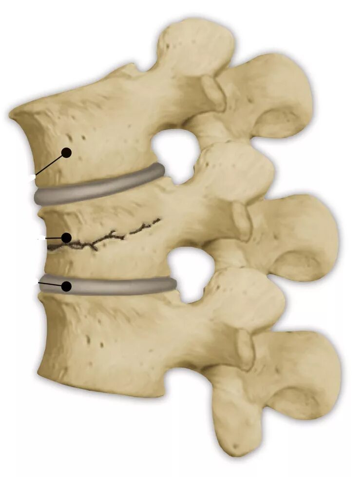Компрессионный перелом тела т11 позвонка. Компрессионный перелом позвоночника l5. Неосложненный компрессионный перелом позвоночника. Компрессионный перелом th10 позвонка.
