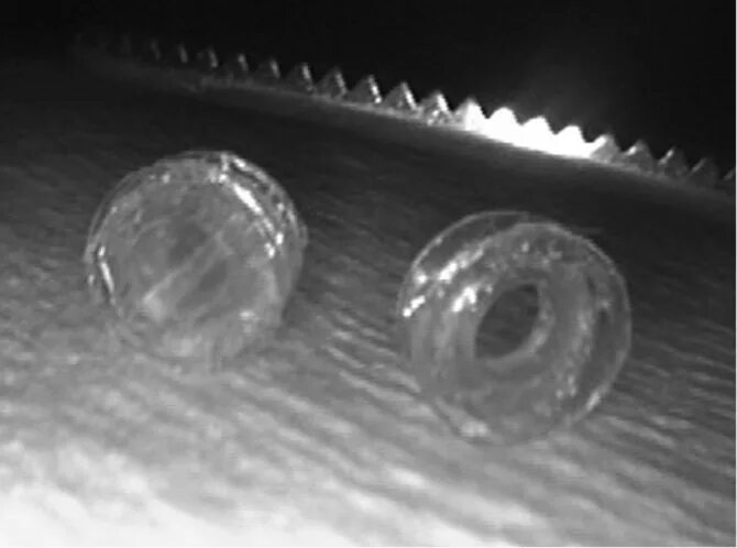 Шунтирование стентирование протезирование. Манганиновый шунт. Титановый шунт. Шунт раппопорта. Кортикомедуллярный шунт.