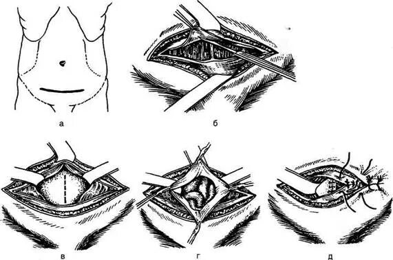 Поперечная лапаротомия по Пфанненштилю. Нижняя поперечная лапаротомия по Пфанненштилю. Лапаротомия по Пфанненштилю кесарево. Нижнесрединная лапаротомия по Пфанненштилю.