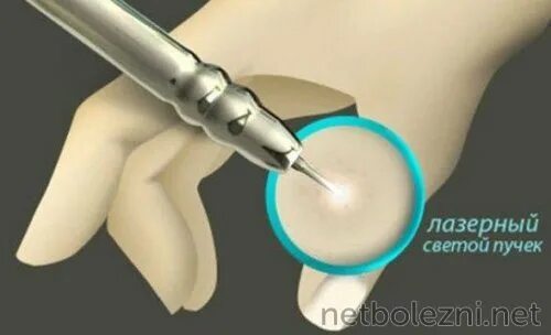 Клиника реалайз череповец. Удаление лазером череповец. Ищу модель для удаления тату бесплатно. Дмитров лазерное удаление. Удаление лазером череповец.