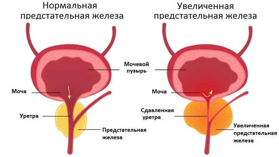 Предстательная железа функции у мужчин. Мочевой пузырь и предстательная железа. Сектора предстательной железы. Увеличение предстательной железы. ДГПЖ предстательной железы что это такое.