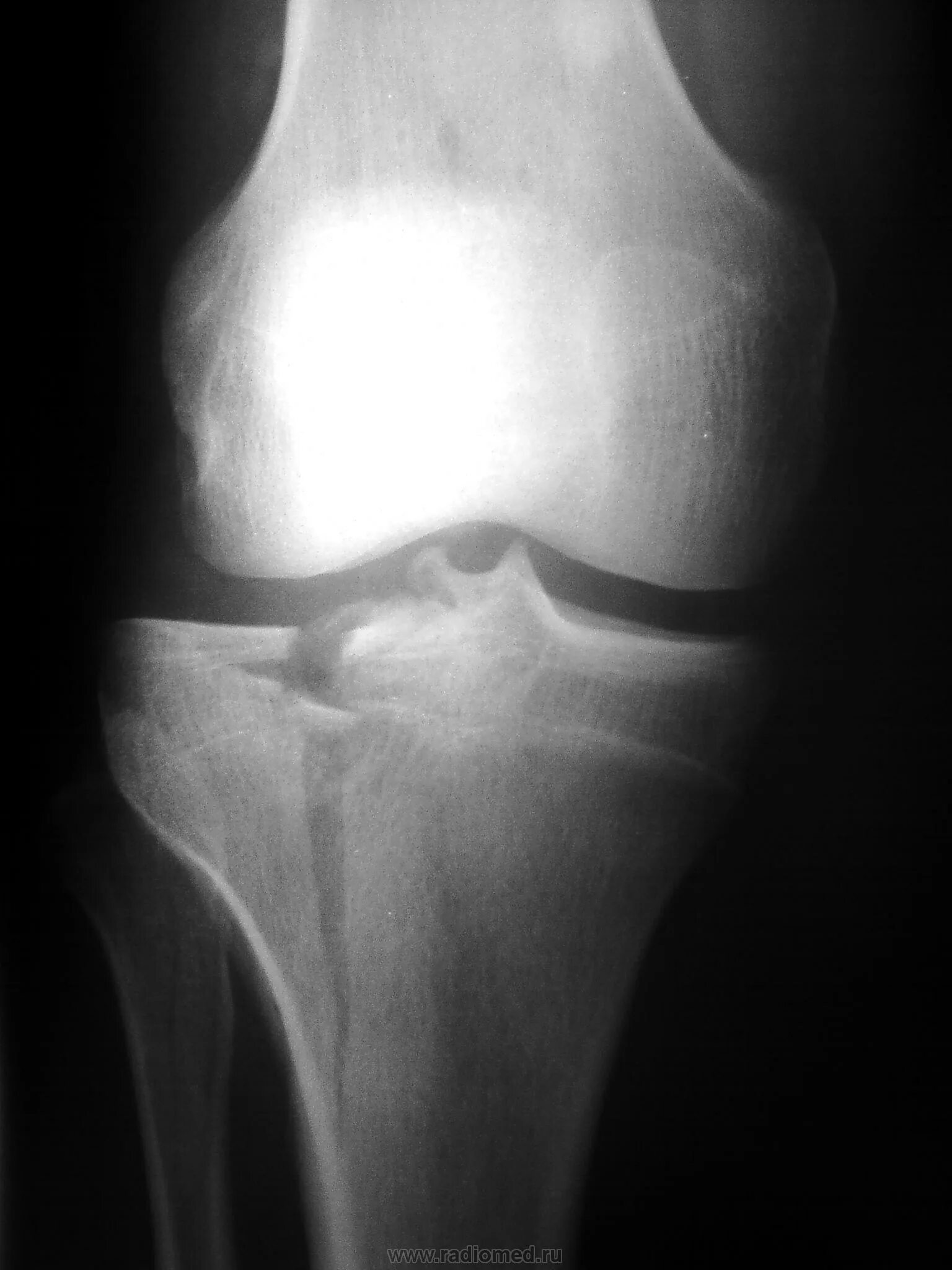 Трещина связке. Надколенник коленного сустава рентген. Коленный сустав рентген связка надколенника. Перелом коленного сустава рентгенограмма.