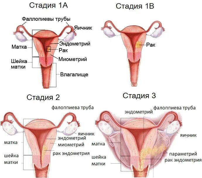 Онкология эндометрия матки. Опухоли тела матки стадии. Карцинома эндометрия 2 стадия. Злокачественные опухоли эндометрия. Онкология эндометрия.