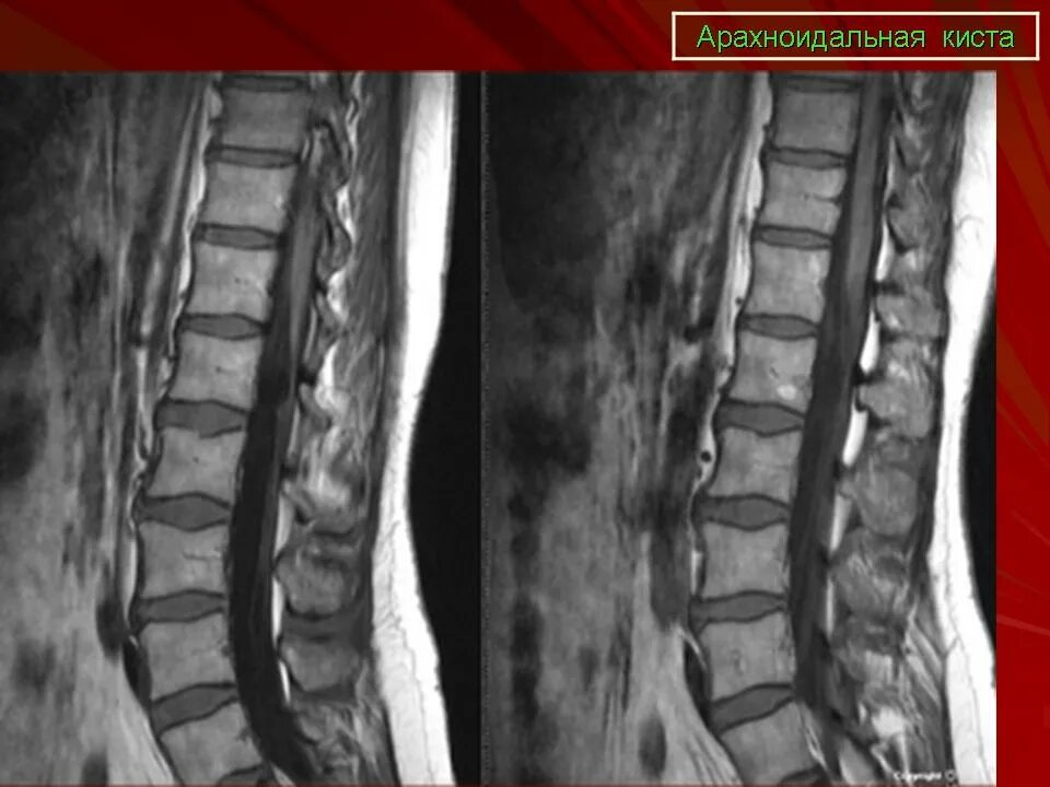Периневральная киста l5-s1. Конвекситальная арахноидальная киста. Арахноидальная киста позвоночника s2. Операция кисты позвоночника