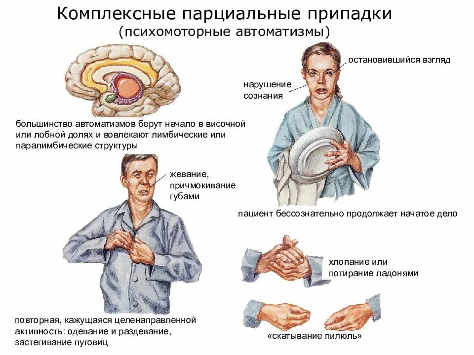 Сложные парциальные припадки. Сложные парциальные приступы при эпилепсии. Комплексные парциальные припадки. Простые парциальные припадки эпилепсии симптомы. При эпилепсии дают инвалидность