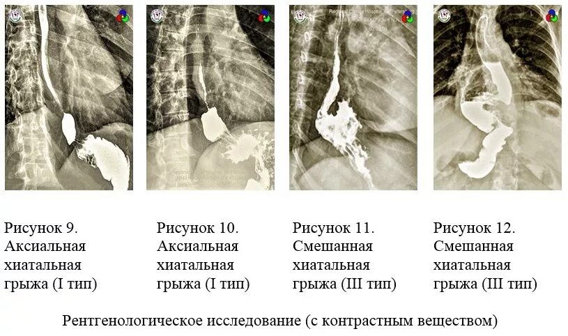 Можно ли вылечить грыжу пищевода. Аксиальная хиатальная грыжа. грыжа пищеводного отверстия диафрагмы рентген классификация. аксиальная скользящая грыжа рентген. аксиальная грыжа пищевода рентген.