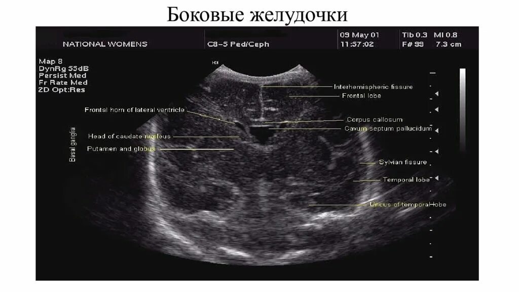 УЗИ головного мозга нейросонография. УЗИ желудочков головного мозга плода. Третий желудочек головного мозга плода на УЗИ. Задние рога боковых желудочков плода норма по УЗИ. Расширение рогов боковых желудочков