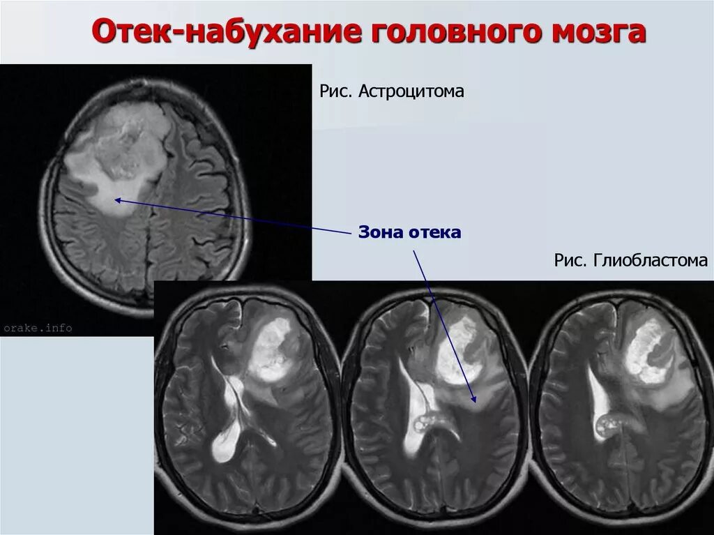 Отек мозга g 93.6 причина. Отечность головного мозга.