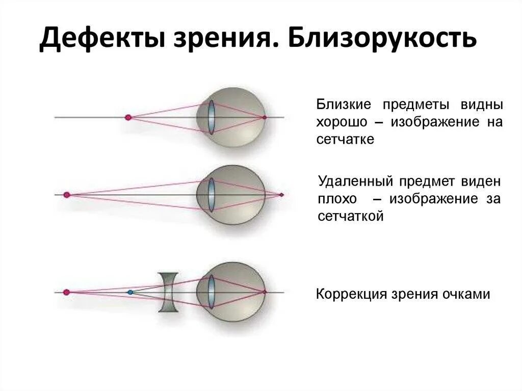 Глаз имеет оптическую силу. Дефекты зрения близорукость. Дефекты зрения близорукость и дальнозоркость. Глаз близорукость и дальнозоркость физика. Оптические дефекты зрения.