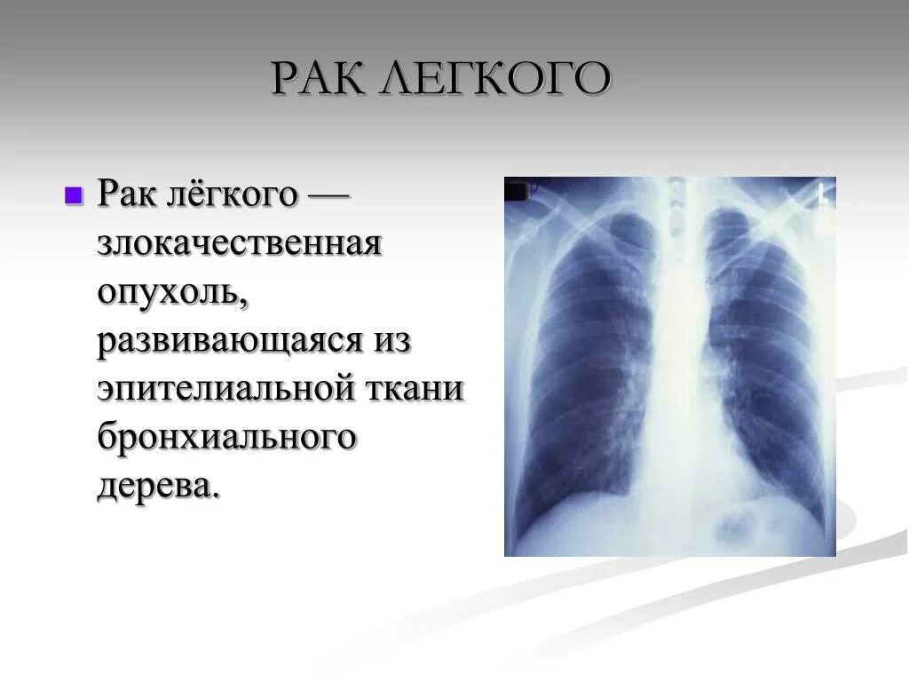 Дать определение легких. Злокачественная опухоль легких. Новообразование в легких.