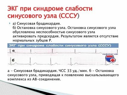 Синдром синусового узла лечение